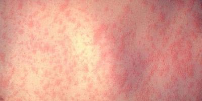 Example of the measles rash