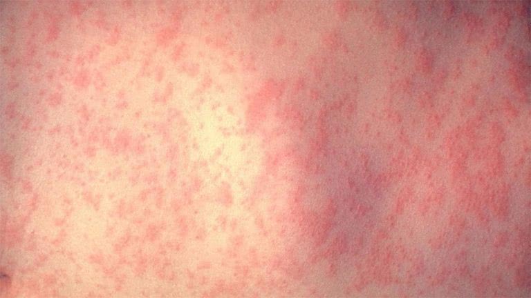 Example of the measles rash