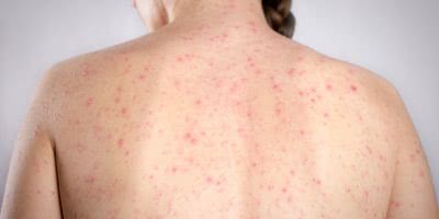 victoria measles warning