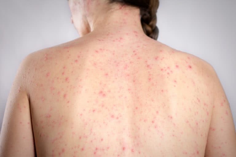 victoria measles warning