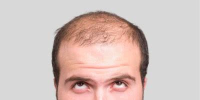 hair loss feature