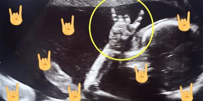 Ultrasound of a baby throwing up “Sign of the Horns"
