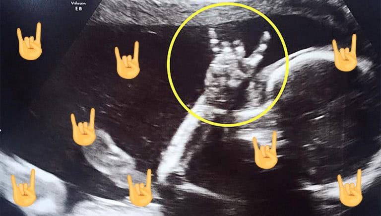 Ultrasound of a baby throwing up “Sign of the Horns"