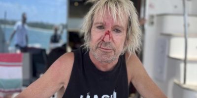 Aussie rocker has suffered a bloody face injury after partying on a yacht