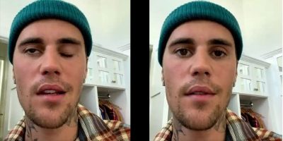 Justin Bieber reveals facial paralysis