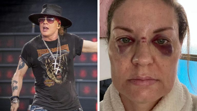 guns n' roses show mic bruised face fan